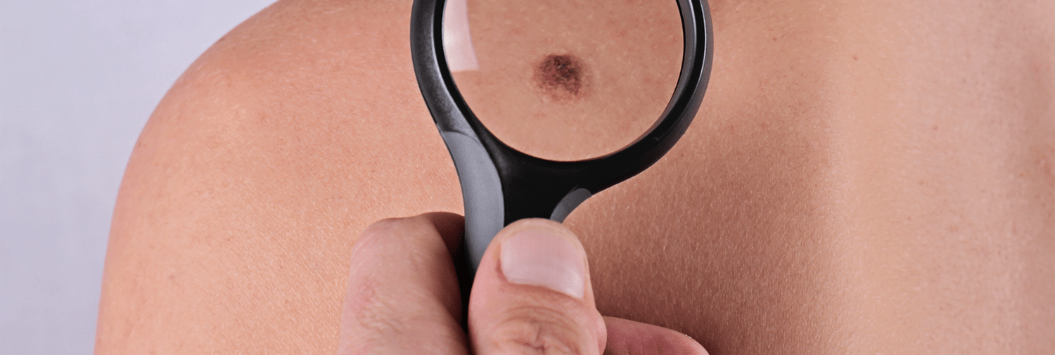 checking mole on skin