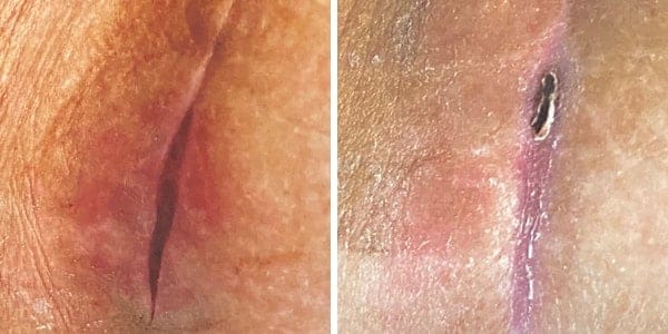 before and after incision
