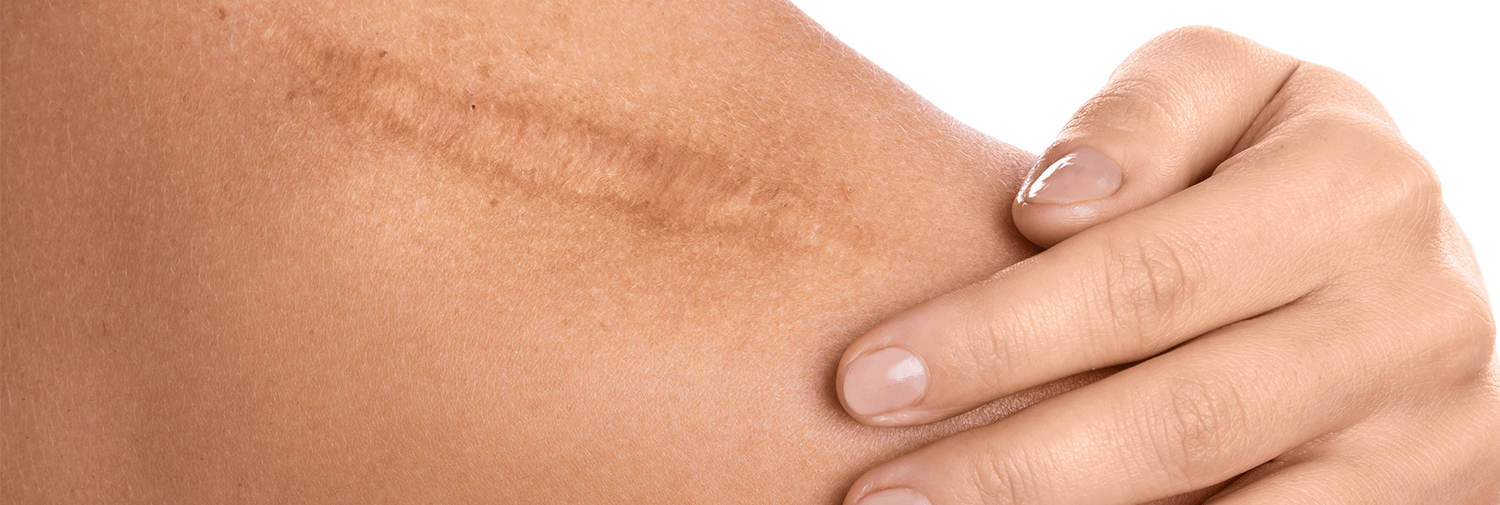 woman with scar on shoulder