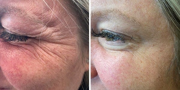 before and after with botox treatment