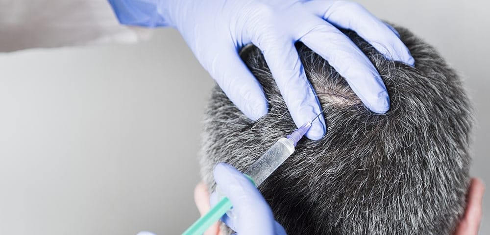 doctor performs prp for hair growth on a man's scalp