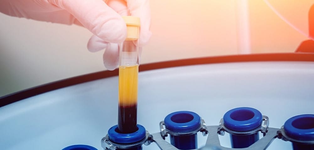 doctors prepares a vial for centrifuge for platelet-rich plasma treatment