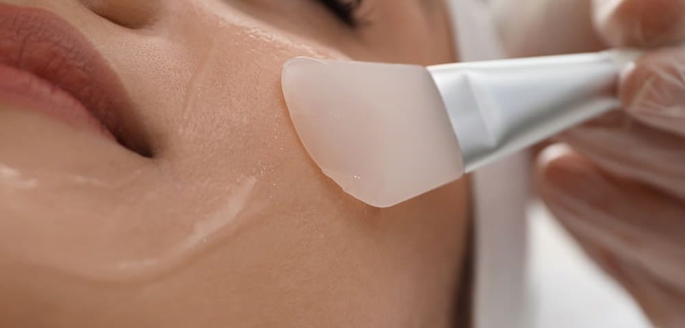 a woman receiving a chemical peel