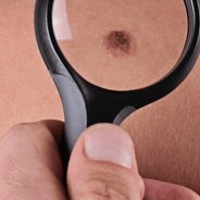 checking mole on skin