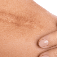 woman with scar on shoulder