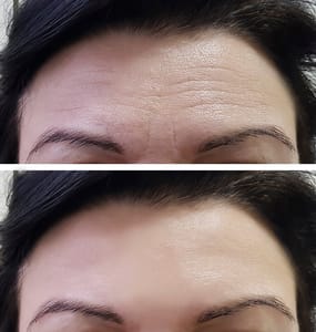 before and after forehead Botox injection