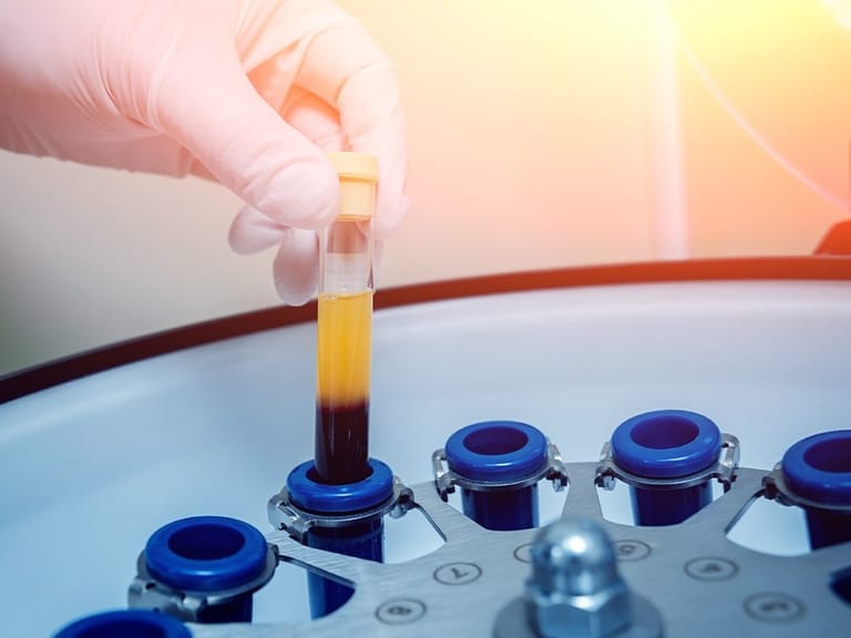 doctors prepares a vial for centrifuge for platelet-rich plasma treatment