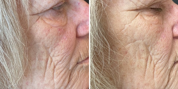 before and after four rf treatments