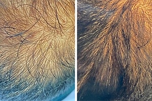 before and after receiving prp for hair growth treatment in Indianapolis, IN