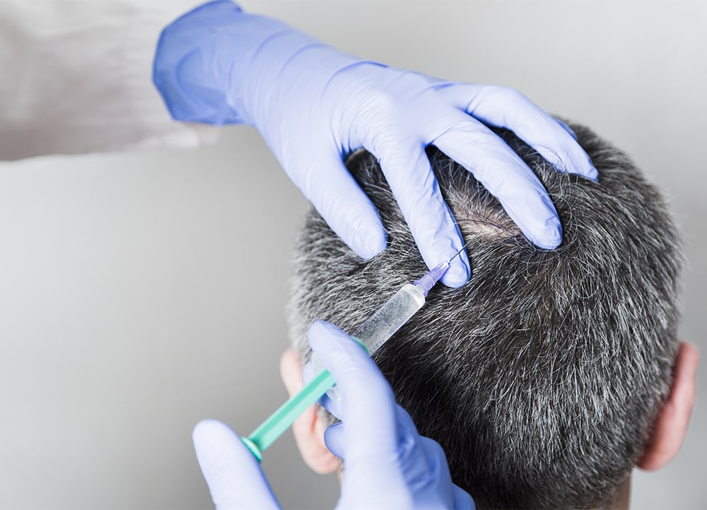 doctor performs prp for hair growth on a man's scalp