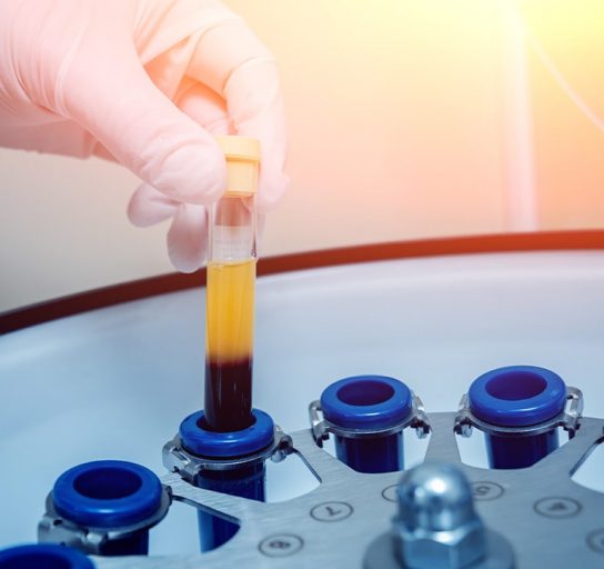 doctors prepares a vial for centrifuge for platelet-rich plasma treatment