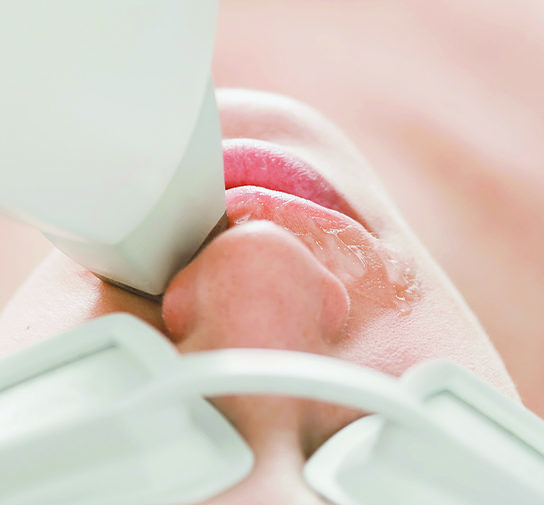 woman undergoing laser hair removal treatment on upper lip